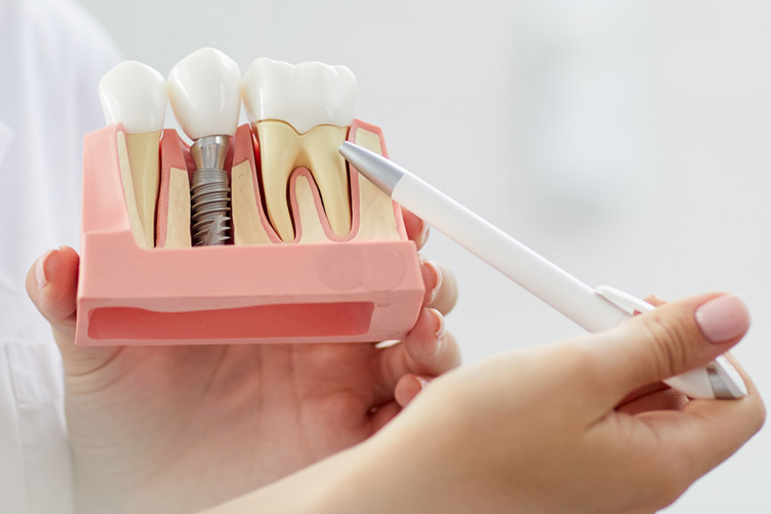 Dental Implants Overview: A Modern Tooth Replacement Solution