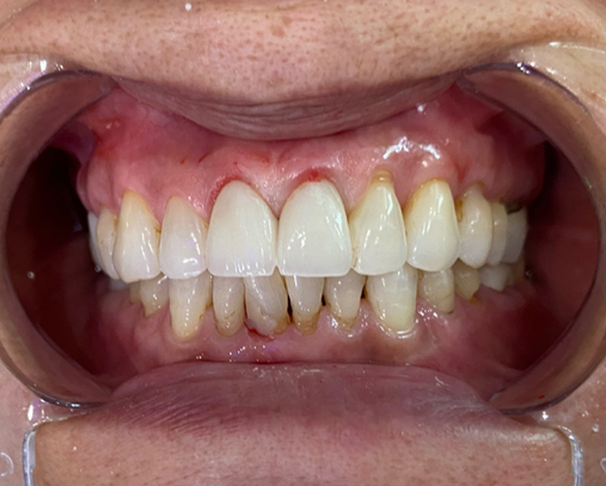 After-Porcelain Fused Zirconia Crowns Before & After Photo