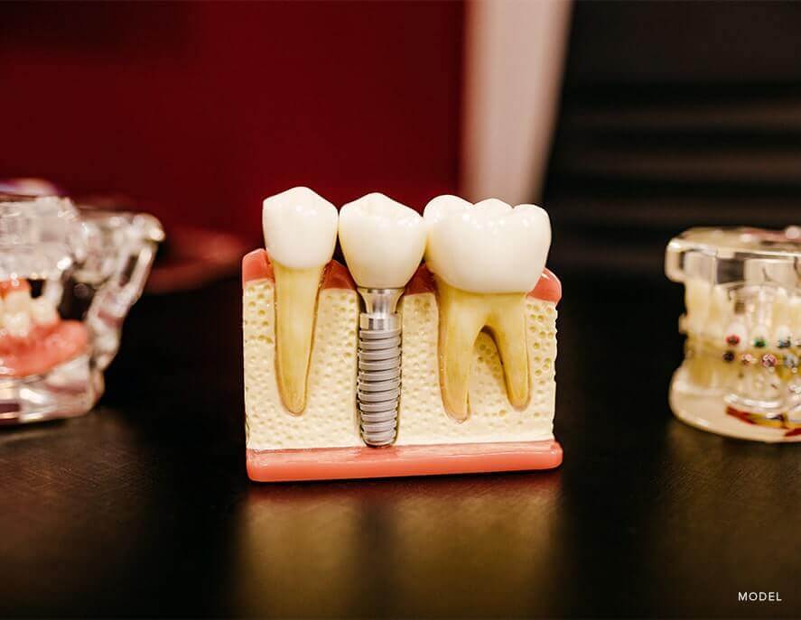 Here's everything you need to know about dental implants