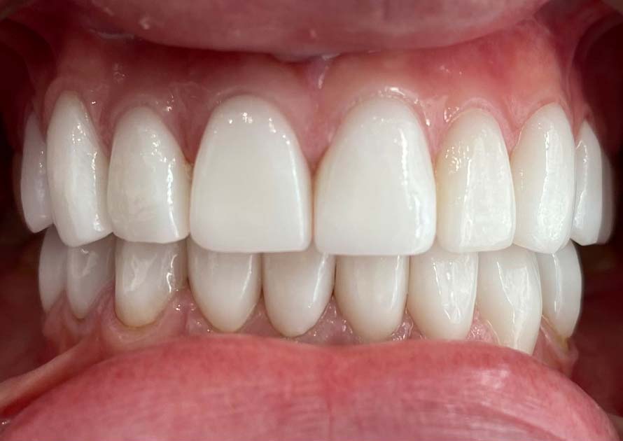 After-Dental Veneers Before and After