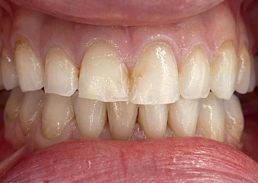 Before-Dental Veneers Before and After