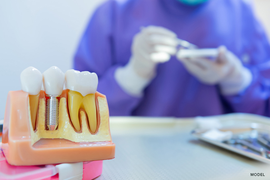 dental implant planning