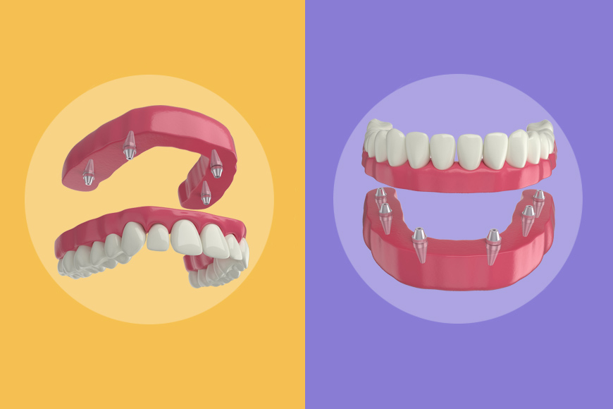 Choosing A Dental Implant Type: All-On-4 Vs All-On-6