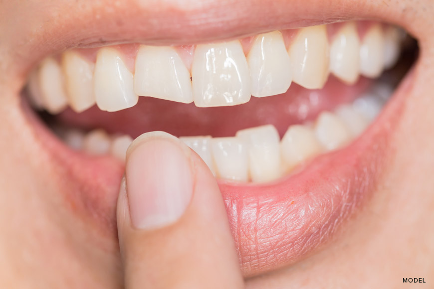 Chipped Tooth: Causes, Symptoms, and Treatment Options