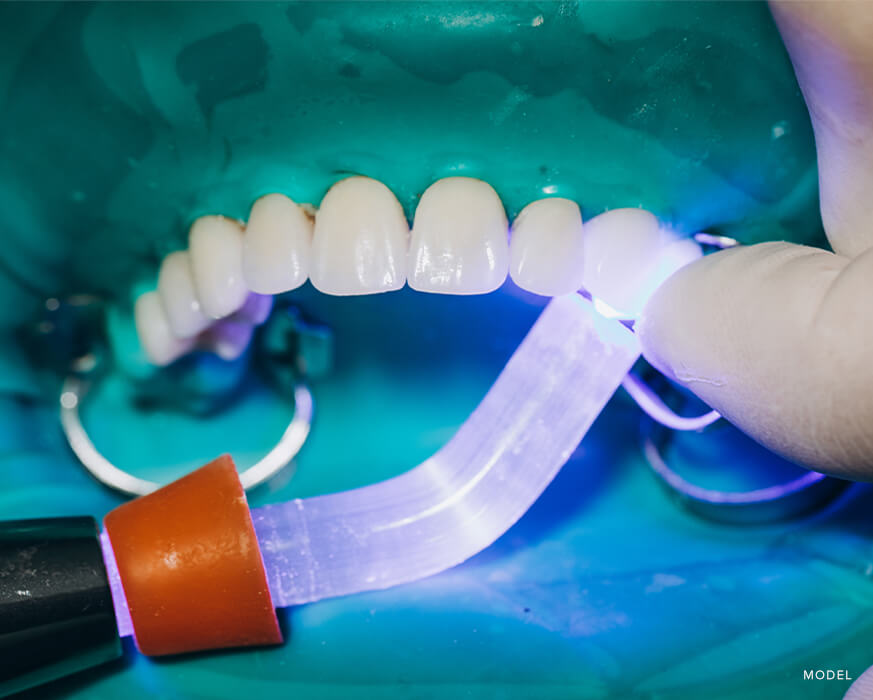 Everything need to know about dental crowns