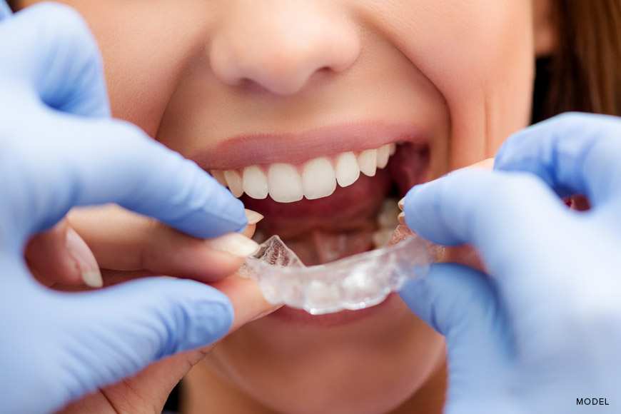 What To Expect During Your Invisalign Appointment