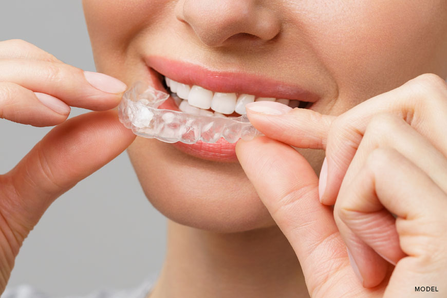 Invisalign Process: A Step-by-Step Guide to Invisalign Treatment