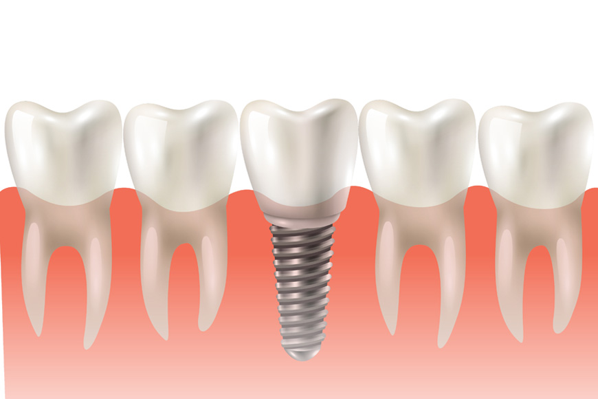 Different Types of Dental Implants: Which One Is Right for You?