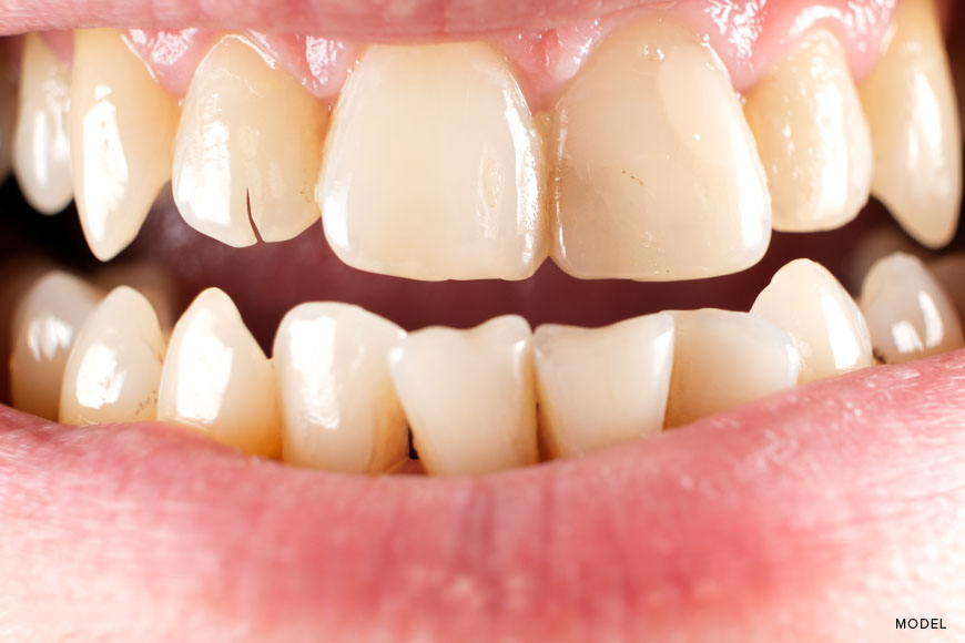 When Is a Broken Tooth a Dental Emergency?
