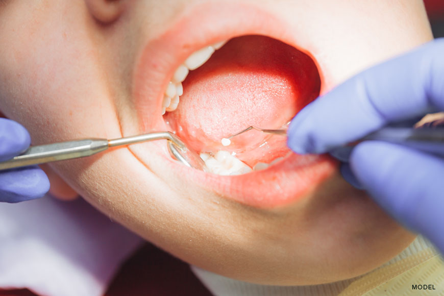Emergency Root Canal: When Is It Necessary?