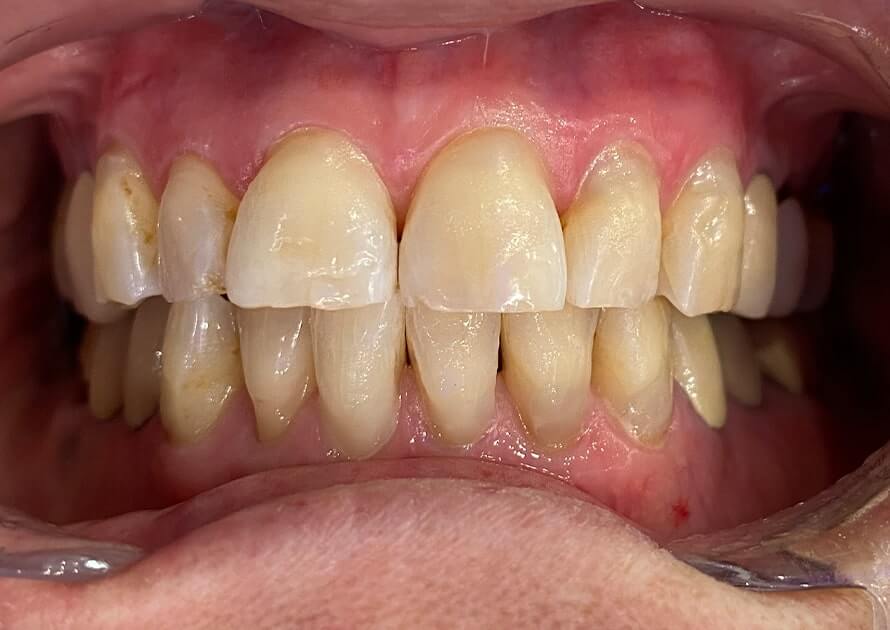 Composite Fillings After