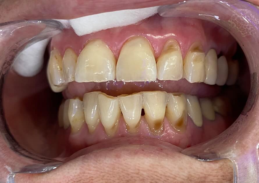 Composite Fillings Before