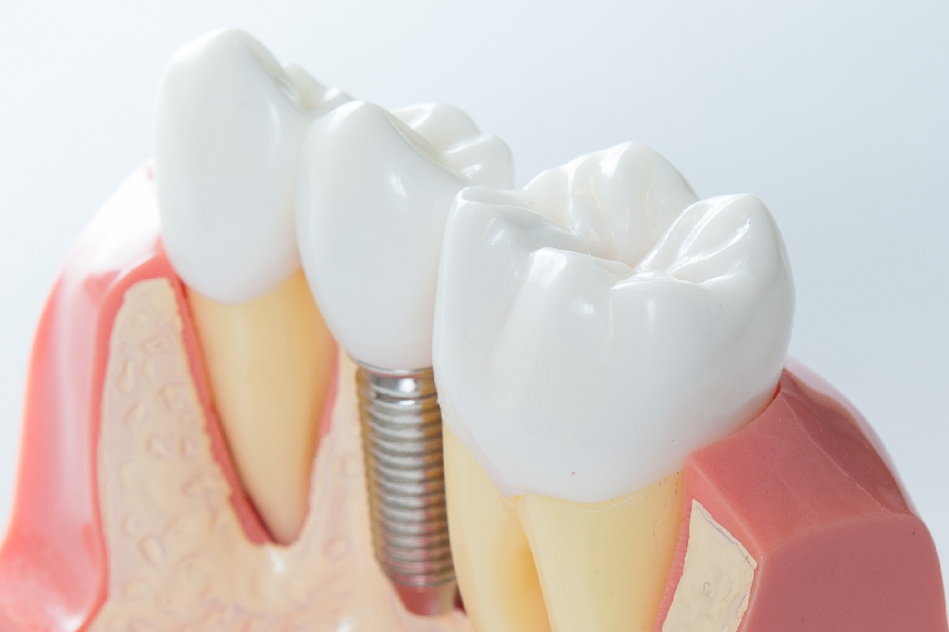 Dental Implants and Safety: How Safe Are Dental Implants?