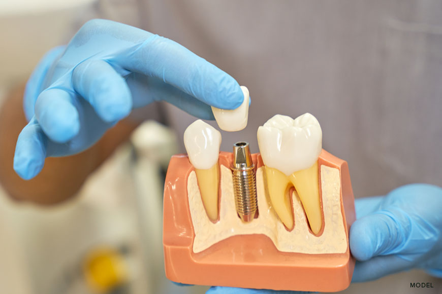 Dental Implants vs Bridges: Which is Right for Your Smile?