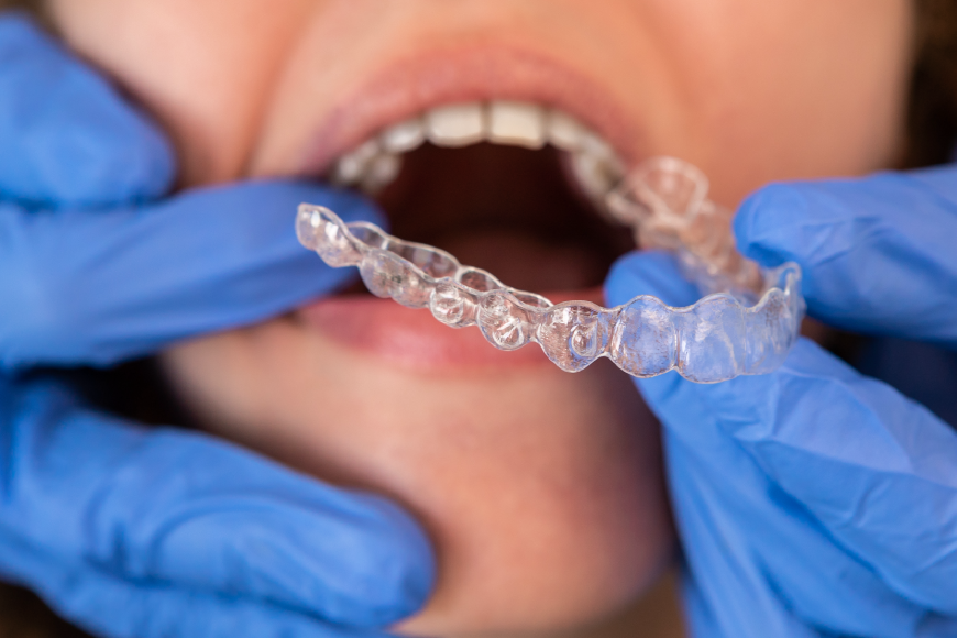 Invisalign braces