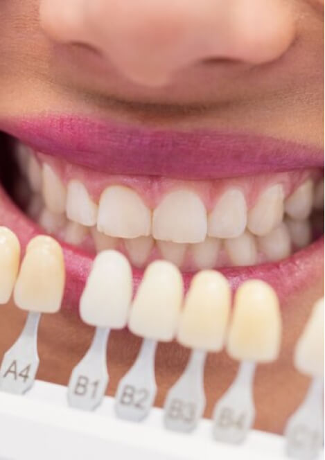 Dental Veneers Placeholder