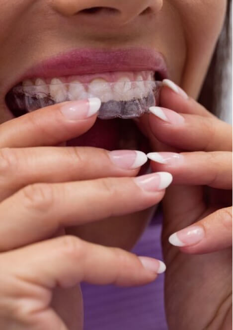 Invisalign treatment placeholder