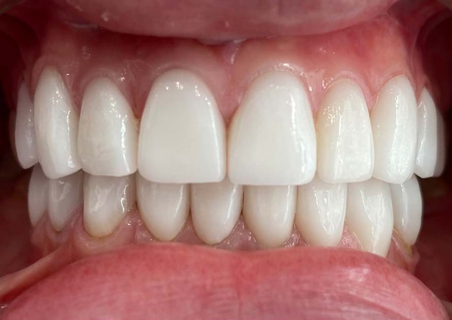 dental veneers after