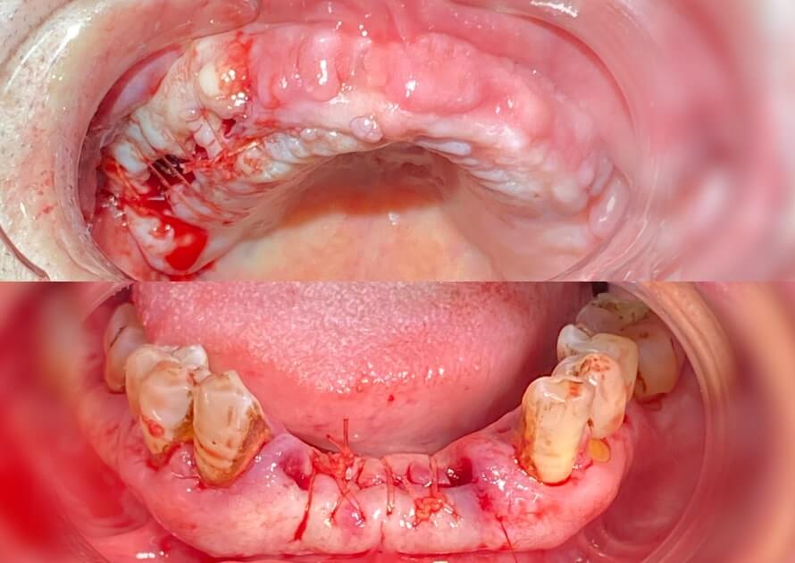 Dentures before