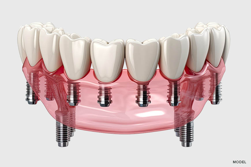 A Complete Guide to the Step-by-Step Process of Full Arch Implantation