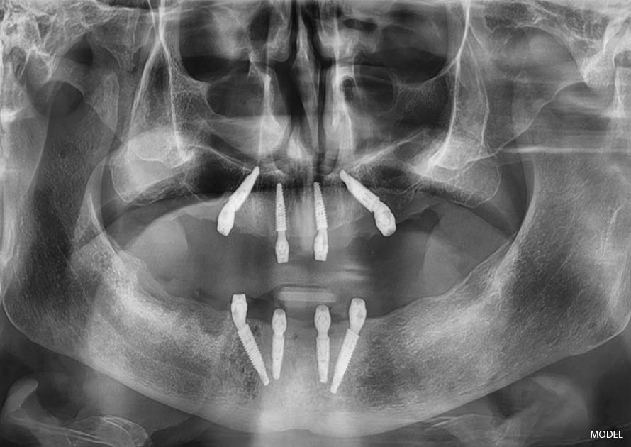 full mouth extraction and all-on-4 implants after