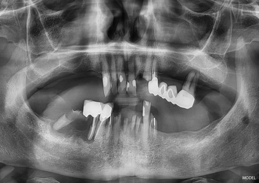 full mouth extraction and all-on-4 implants before