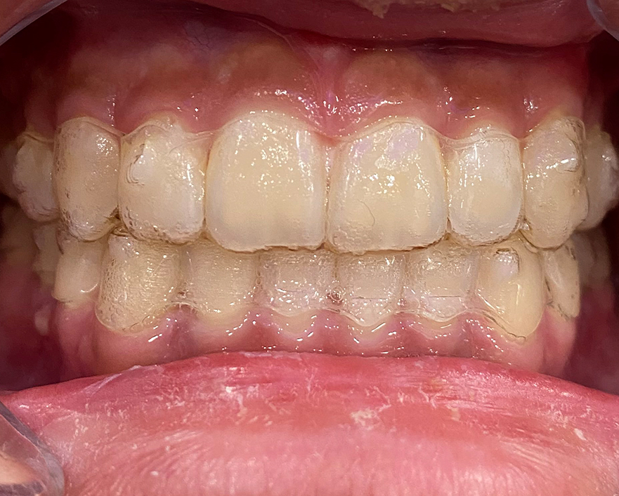 invisalign after