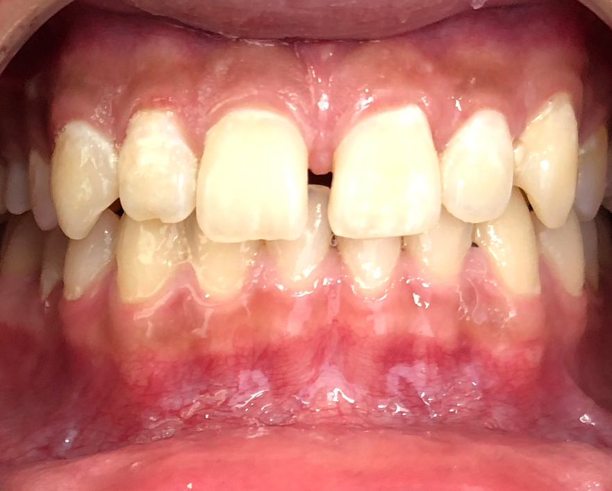 invisalign before