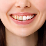 How To Whiten Yellow Teeth