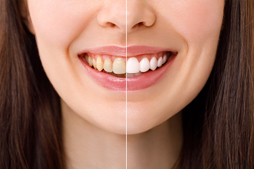 How To Whiten Yellow Teeth: Expert Tips and Home Remedies That Work