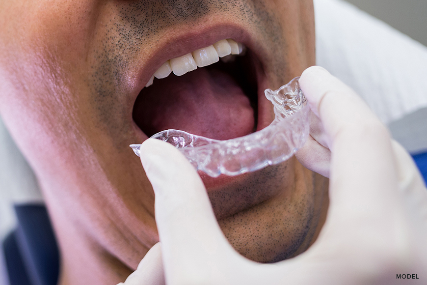Invisalign Cleaning 101: Your Complete Cleaning Manual
