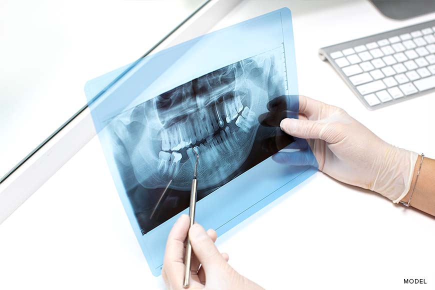 Roles of Panoramic X-Rays in Oral Care