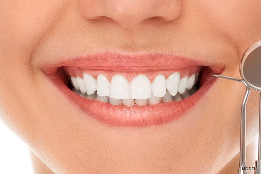 Veneers After Root Canal: Redefining Your Smile