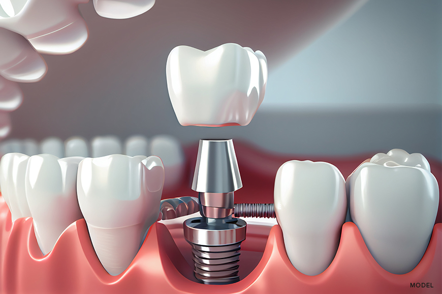 Single Tooth Implants: Precision in Dental Restoration