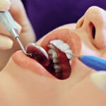 Composite Dental Fillings vs Amalgam: Understanding Your Choices