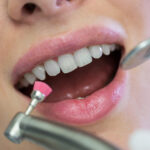 Dental Sealants vs. Dental Fillings: Grasping the Contrast