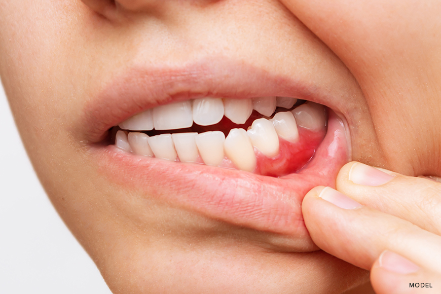 How to Cure Gum Disease: Effective Strategies for a Healthy Smile
