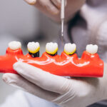 Bone Grafting for Dental Implants Explained