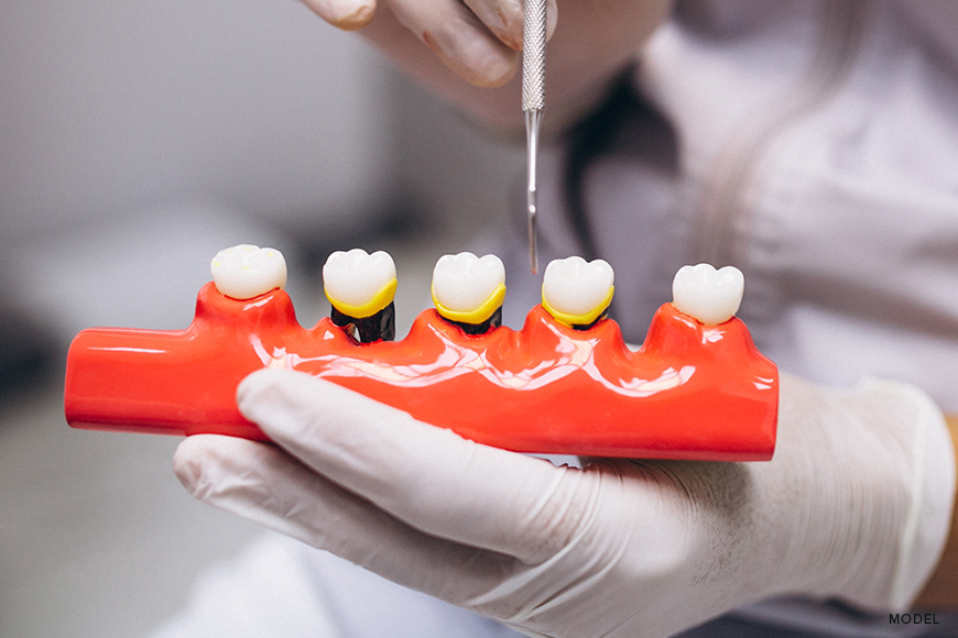 Bone Grafting for Dental Implants Explained