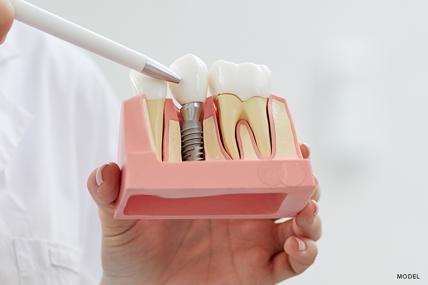 Cost of Bone Grafting for Dental Implants: What You Need to Know