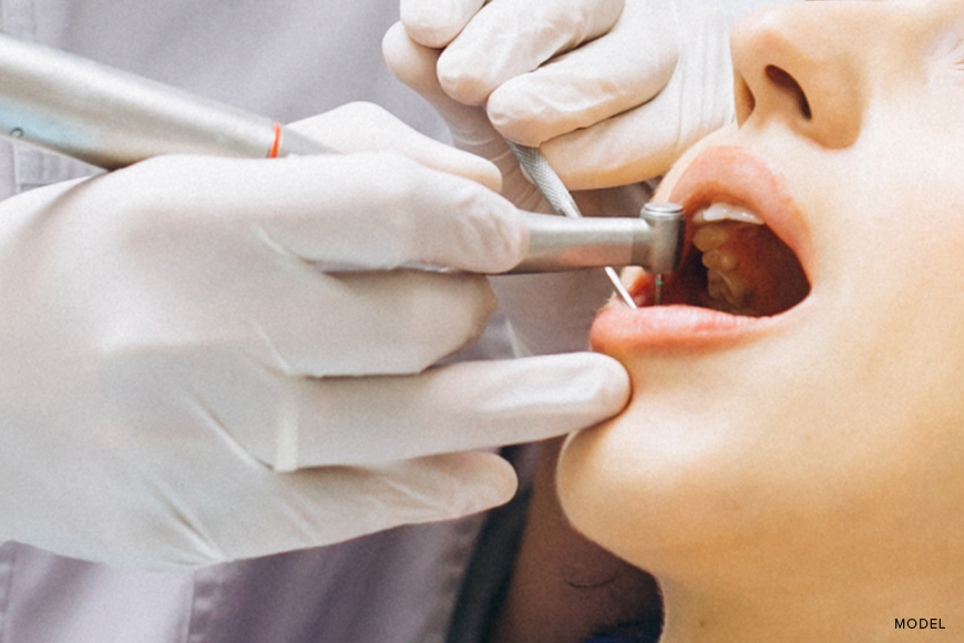 Extracting Four Teeth at Once: What You Need to Know