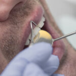 mini dental implants