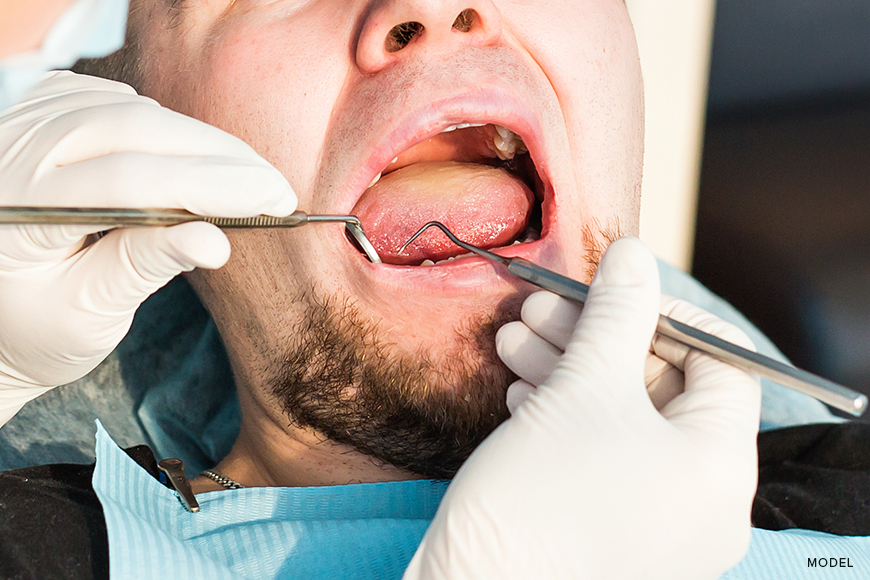 Removing Only One Wisdom Tooth: What You Need to Know