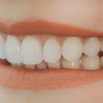 Porcelain Veneers Benefits