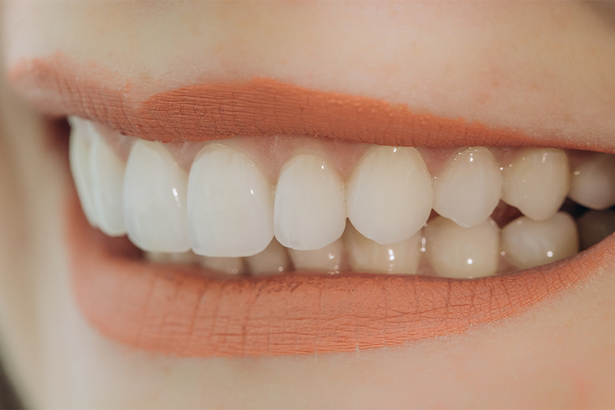 Porcelain Veneers Benefits