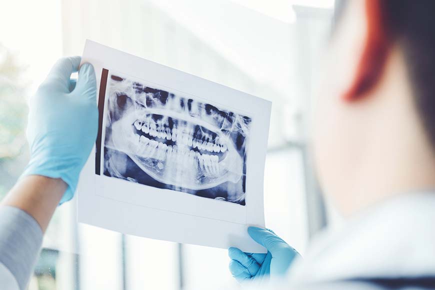 Periapical-Dental-X-Rays