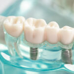 tooth implant side effects