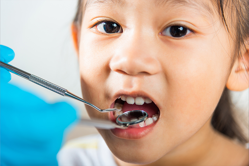 Dental Filling for Kids