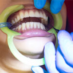 Bleeding Gums Treatment