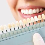 Veneers Pros And Cons